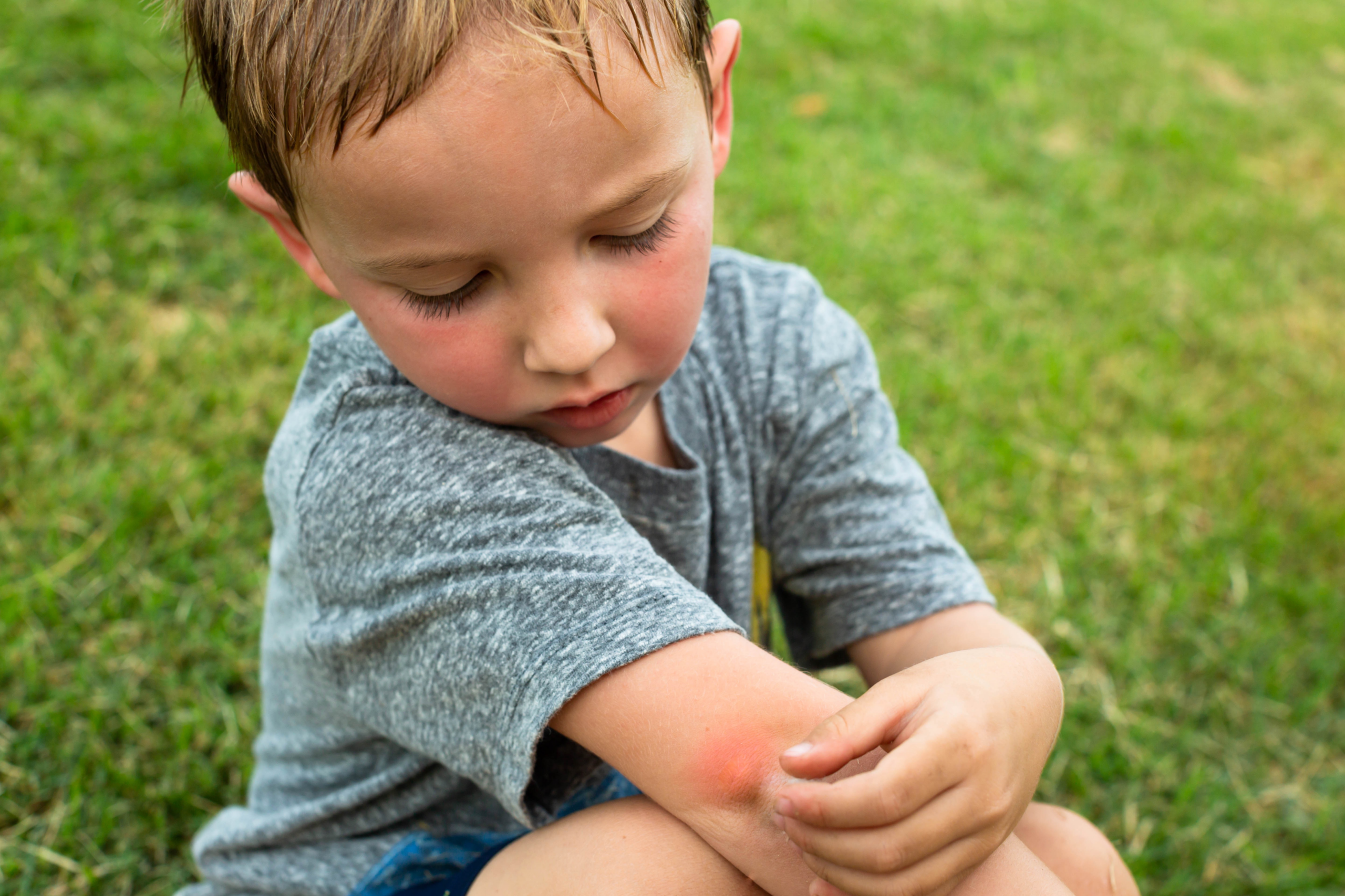 Child outside with a bug bite